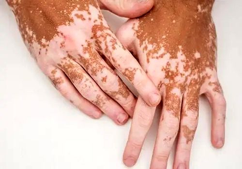 نقش کلیدی ویتامین‌ها در کنترل پیسی