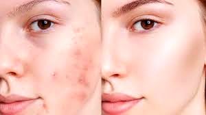 پنج ماده موثر در مبارزه با آکنه 