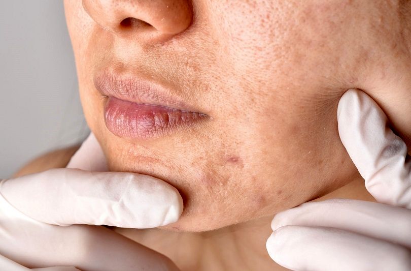 نشانه‌های اولیه سرطان پوست را جدی بگیرید
