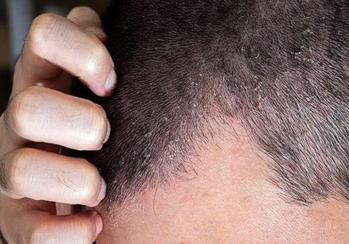 اگزمای پوست سر چگونه درمان می‌شود؟